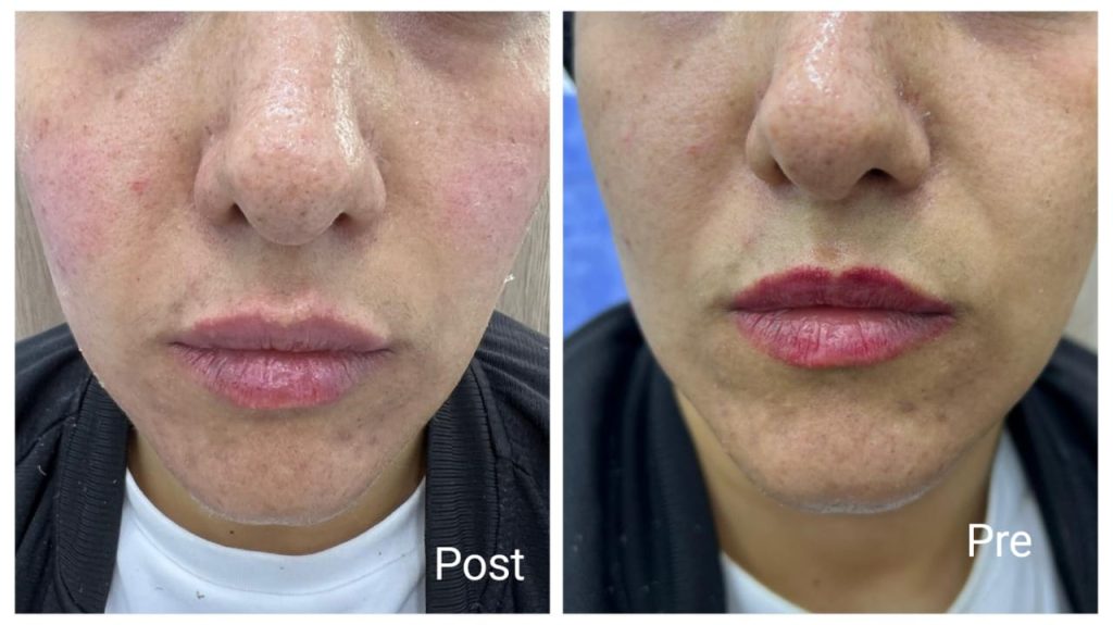 Newfound injection before and after